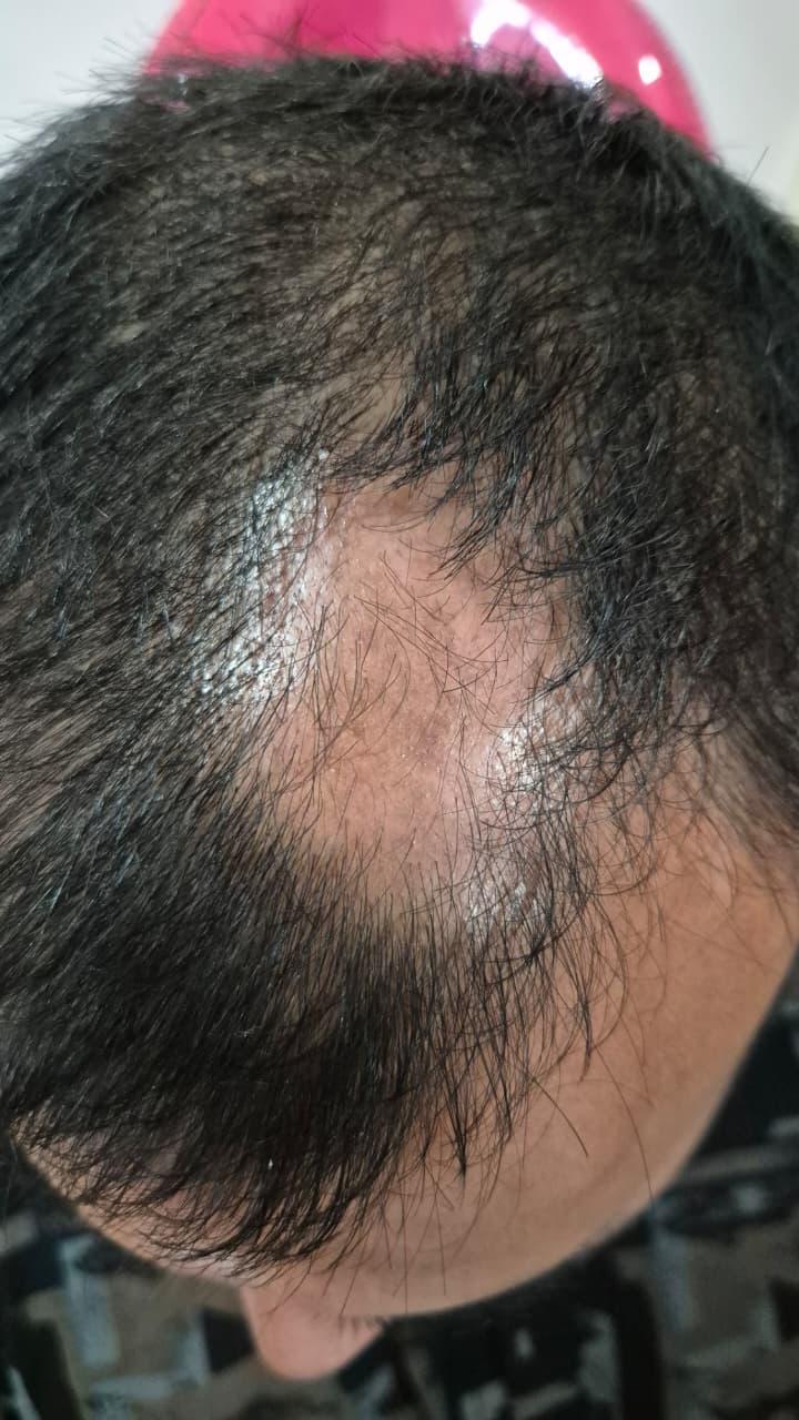 Before Treatment